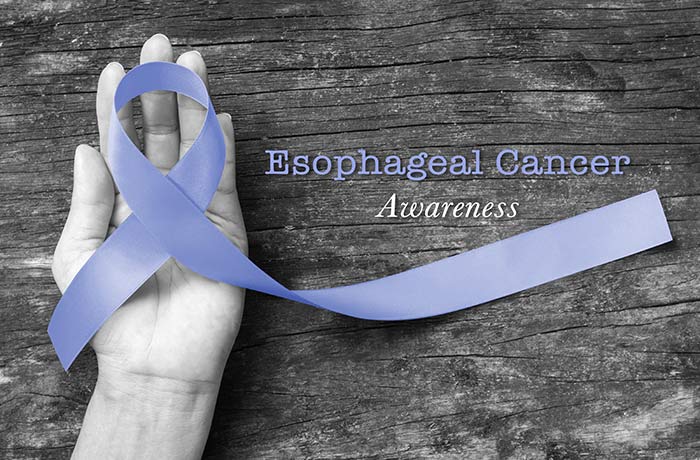 A Closer Look at Esophageal Cancer